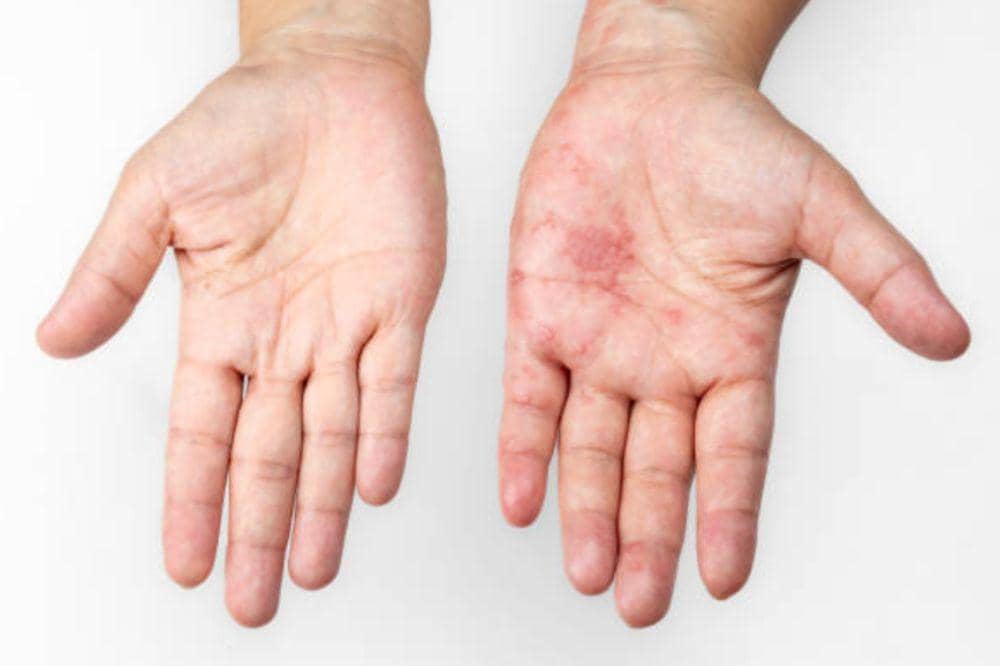 8 Ciri-Ciri Herpes Zoster Mulai Sembuh, Ternyata Bisa Pulih Cepat!