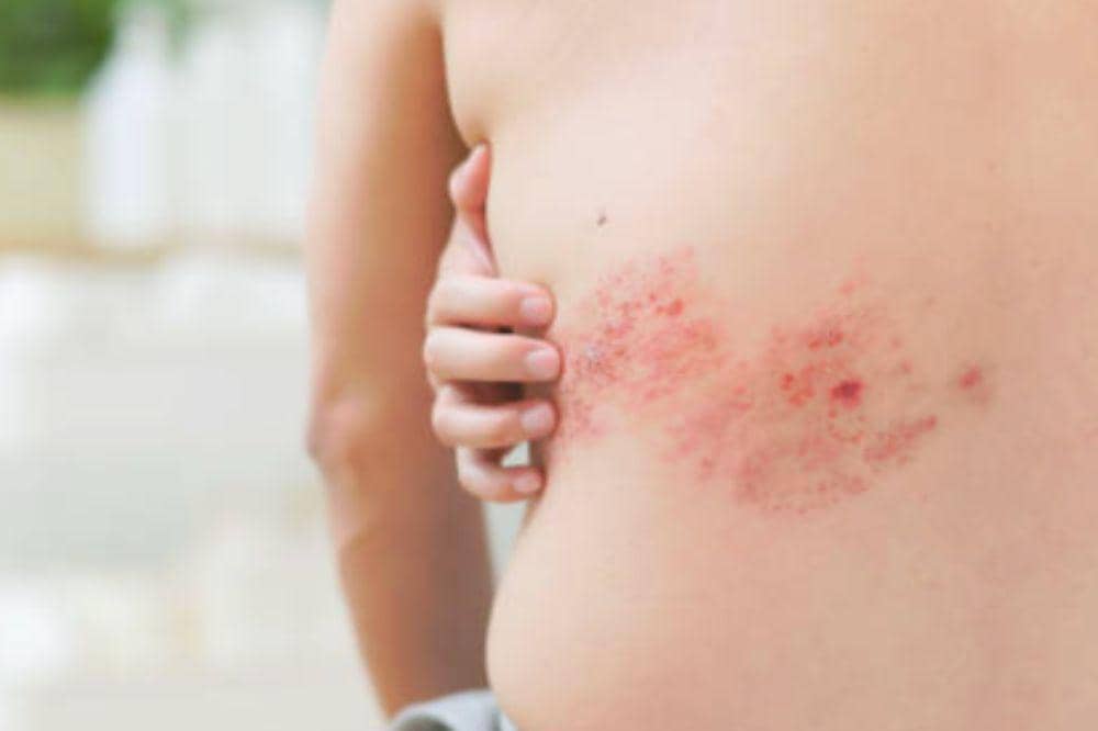 Apa itu Herpes? Kenali Cara Penularan dan Pengobatannya!