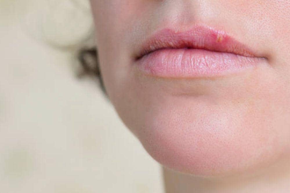 Apa itu Herpes? Kenali Cara Penularan dan Pengobatannya!
