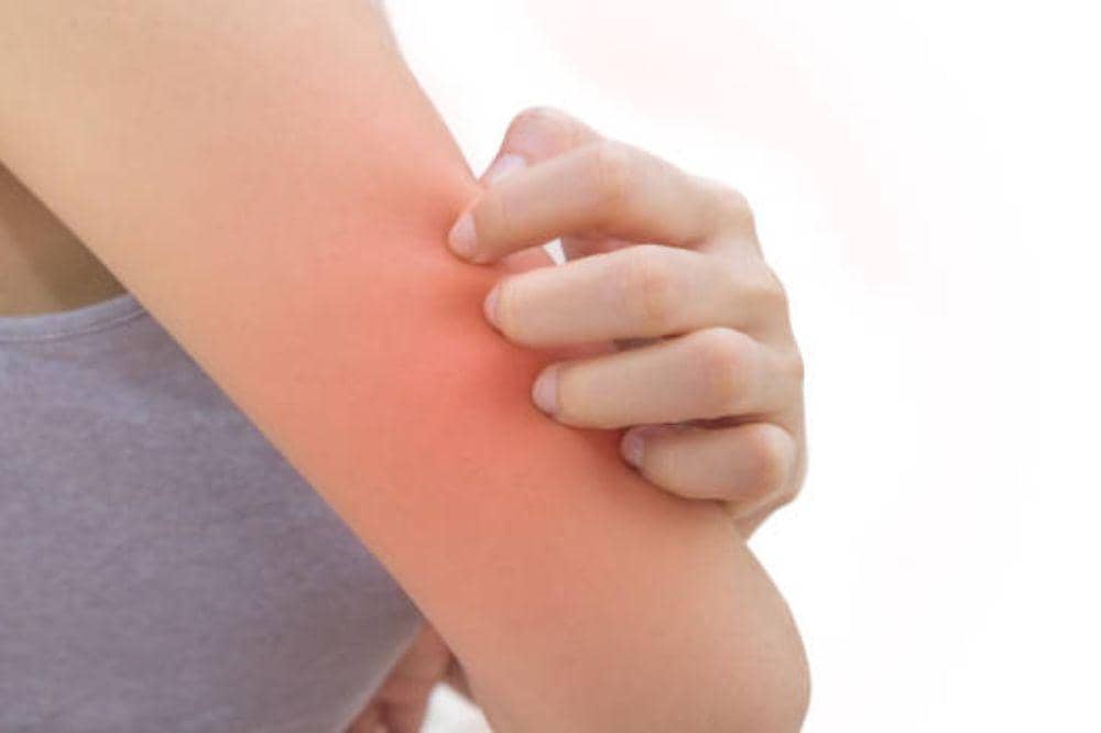 6 Gejala Biduran Menurut Ahli yang Paling Umum Terjadi