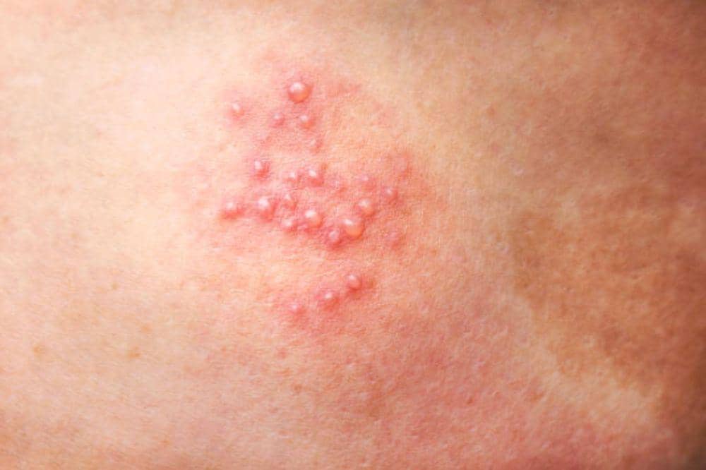 Apa itu Herpes? Kenali Cara Penularan dan Pengobatannya!