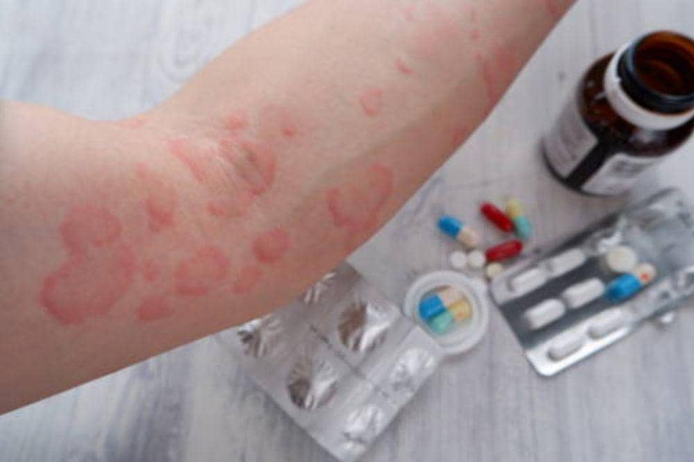 8 Penyebab Biduran yang Sering Terjadi dan Sering Diabaikan