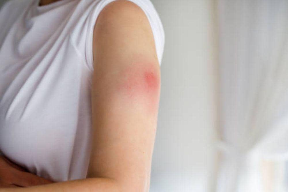 6 Gejala Biduran Menurut Ahli yang Paling Umum Terjadi