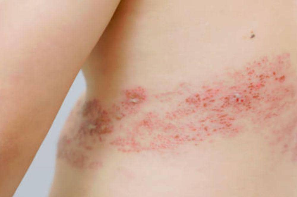 6 Gejala Herpes yang Sering Disangka Sepele, Namun Sangat Menular!