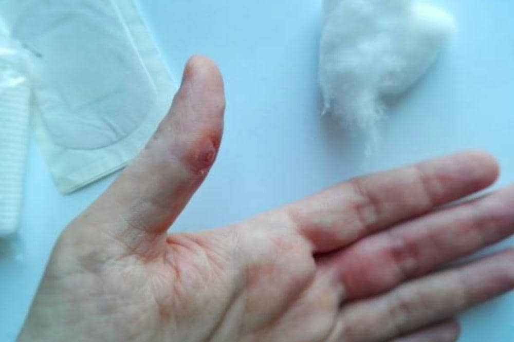 6 Gejala Herpes yang Sering Disangka Sepele, Namun Sangat Menular!