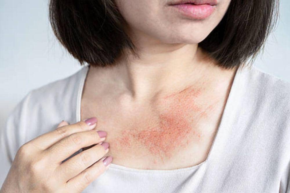 6 Gejala Herpes yang Sering Disangka Sepele, Namun Sangat Menular!