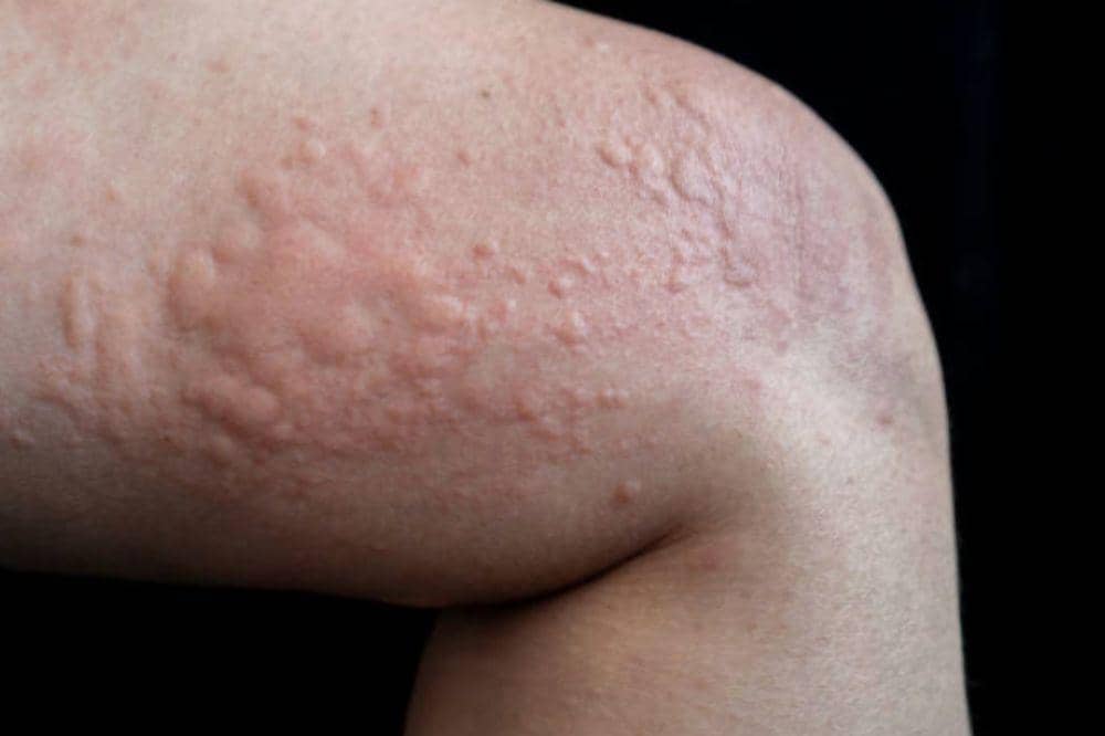 Bagaimana Cara Perawatan Diri untuk Biduran? Mudah Dilakukan!