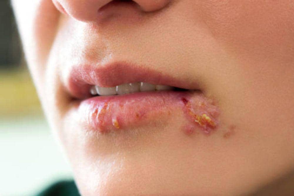 5 Penyebab Herpes yang Jarang Disadari, Nomor 2 Bahaya!