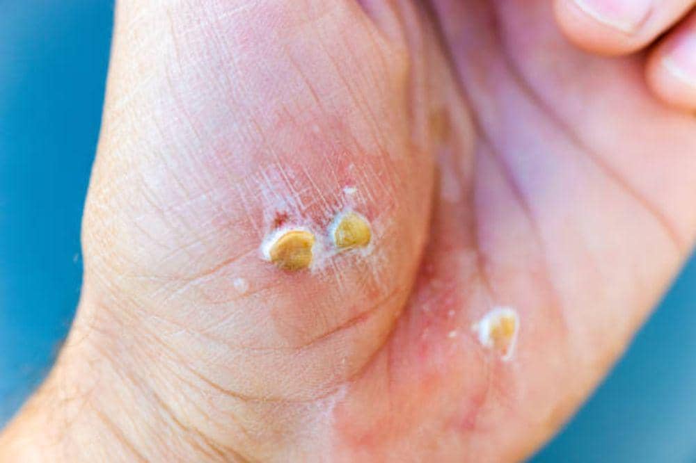 8 Ciri-Ciri Herpes Zoster Mulai Sembuh, Ternyata Bisa Pulih Cepat!