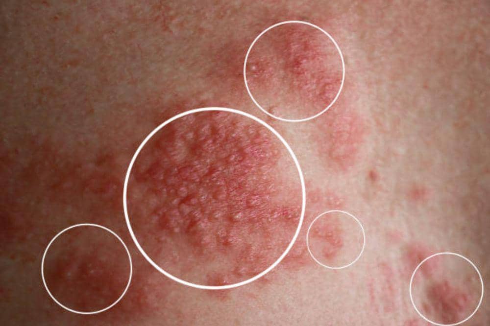 Apakah Herpes Zoster Menular? Ini Fakta Sebenarnya!