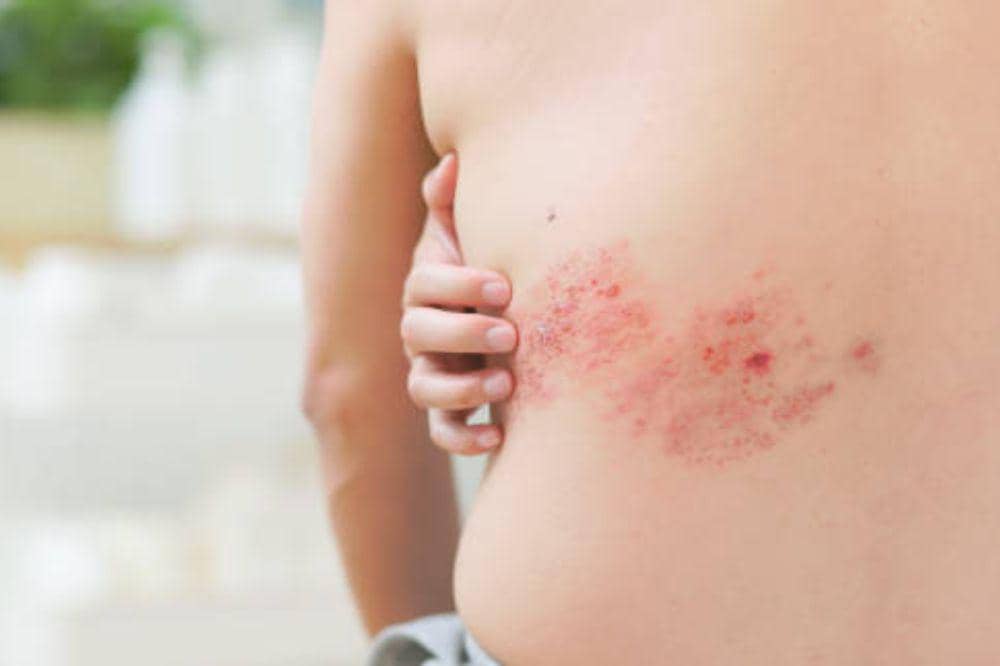 Apakah Herpes Zoster Menular? Ini Fakta Sebenarnya!
