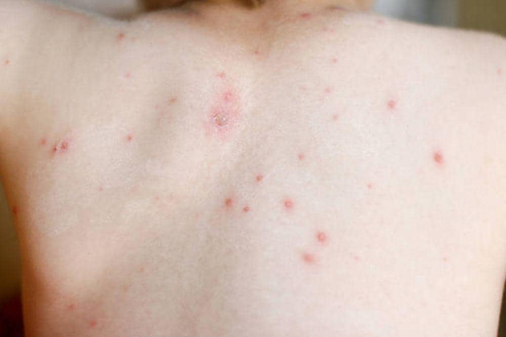 7 Penyebab Herpes Zoster yang Wajib Diwaspadai Menurut Ahli