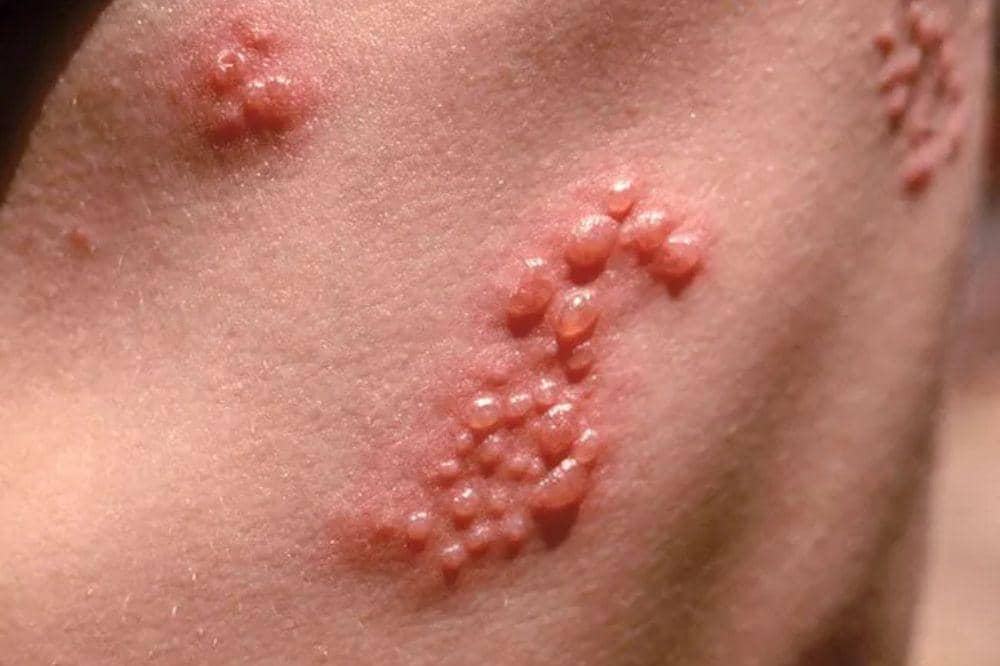 Herpes Kulit Apakah Menular? Begini Virus Bisa Menyebar.jpg
