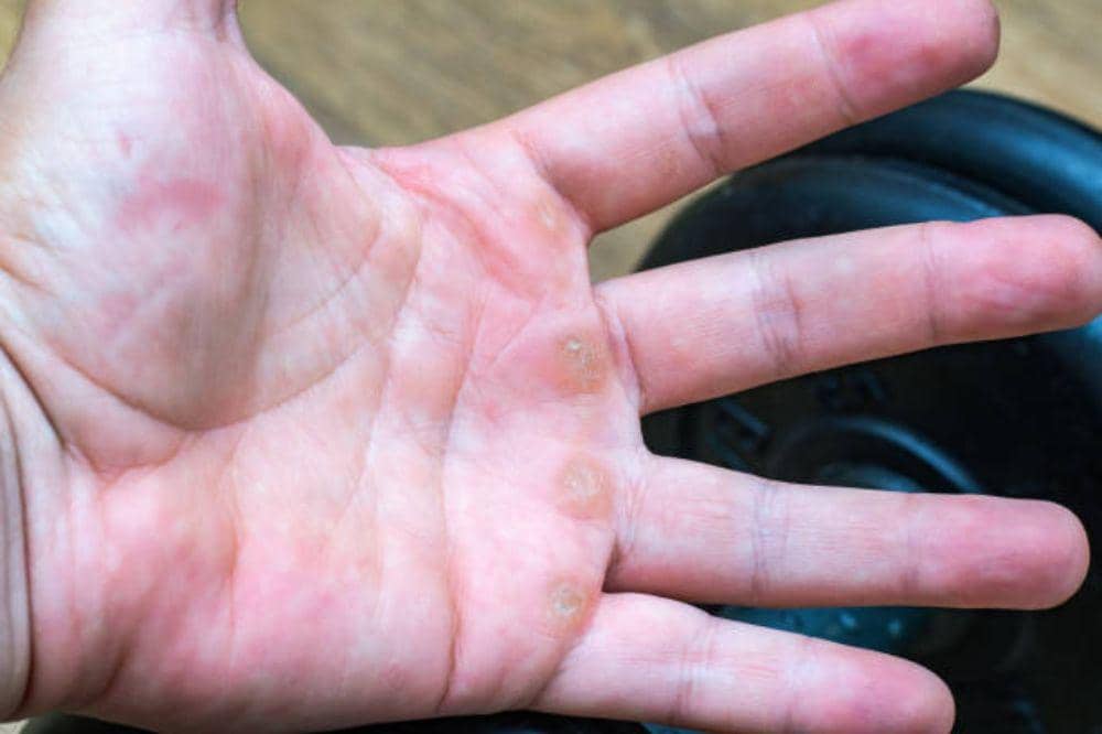 8 Ciri-Ciri Herpes Zoster Mulai Sembuh, Ternyata Bisa Pulih Cepat!