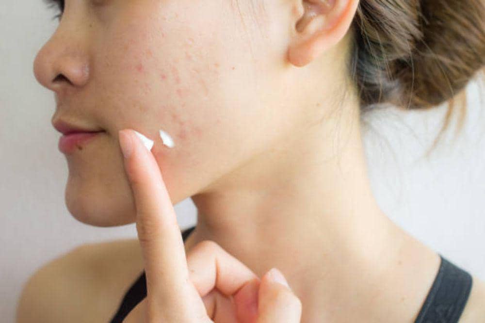 8 Ciri-Ciri Herpes Zoster Mulai Sembuh, Ternyata Bisa Pulih Cepat!