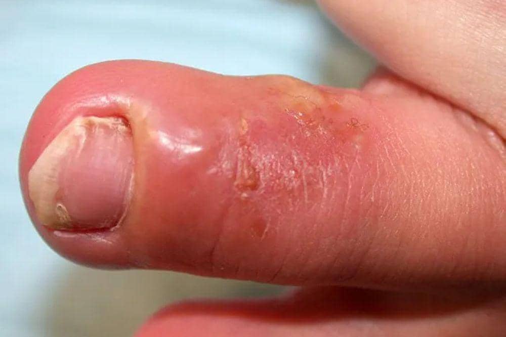 Apa Itu Herpes Kulit? Ini yang Harus Diketahui.jpg