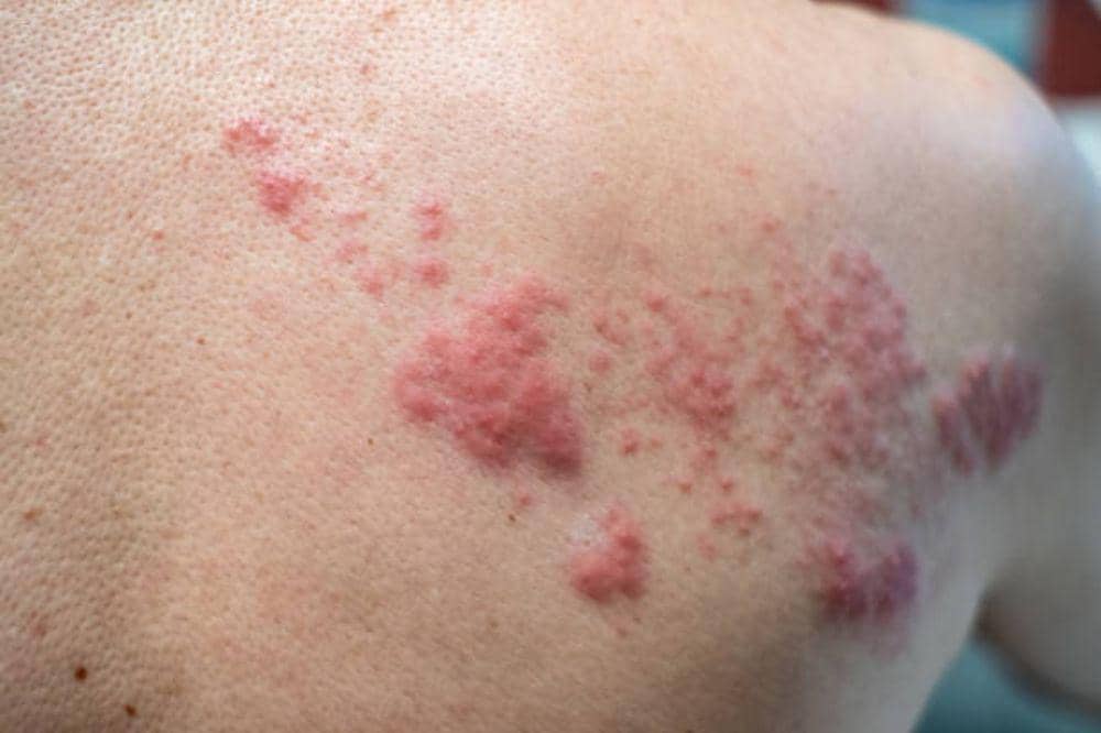 7 Penyebab Herpes Zoster yang Wajib Diwaspadai Menurut Ahli