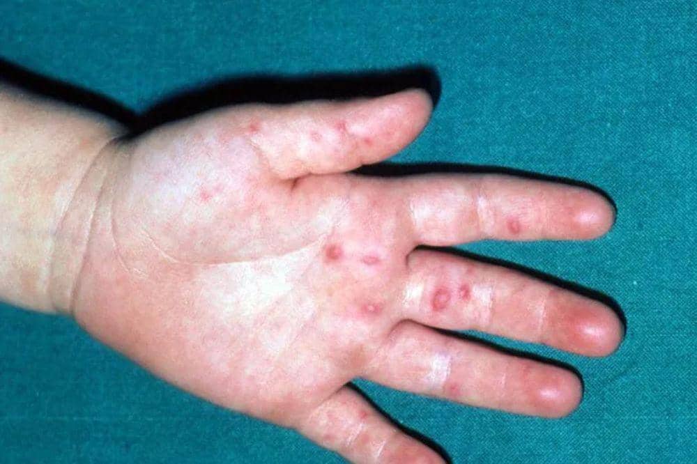 Apa Itu Herpes Kulit Ini yang Harus Diketahui (4).jpg