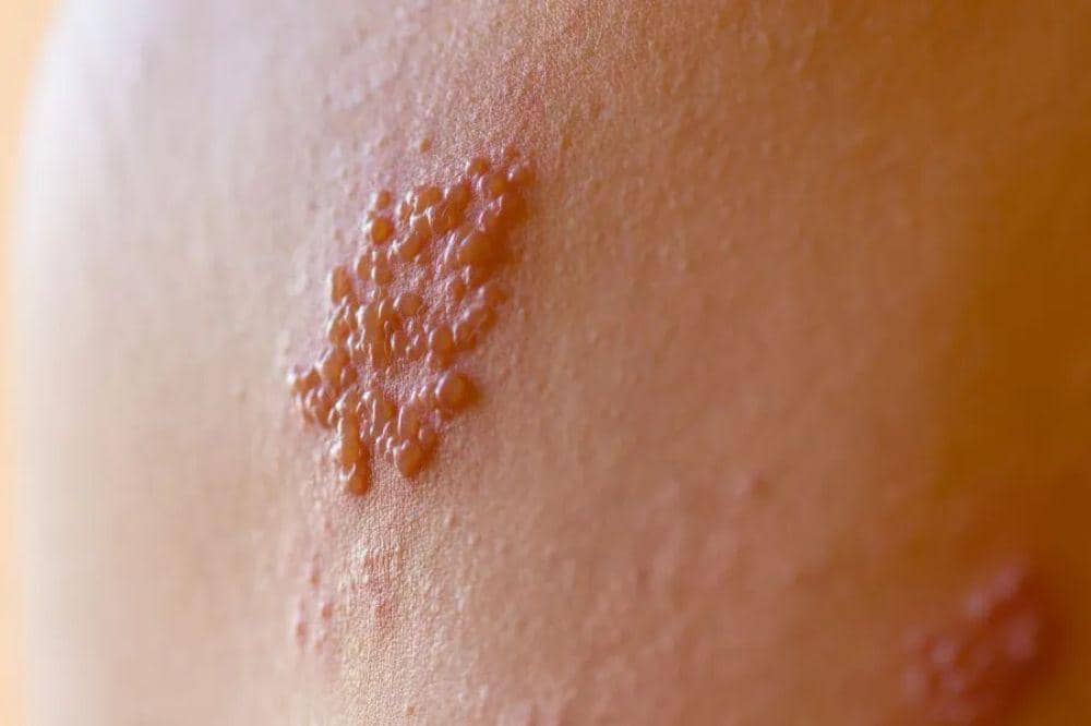 Apa Itu Herpes Genital Info Penting untuk Menjaga Kesehatan Seksual.jpg