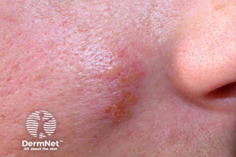 Herpes Kulit Apakah Menular Begini Virus Bisa Menyebar.jpg