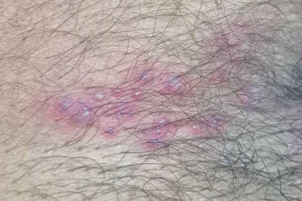 10 Ciri-Ciri Herpes Genital, Salah Satunya Tanpa Gejala!