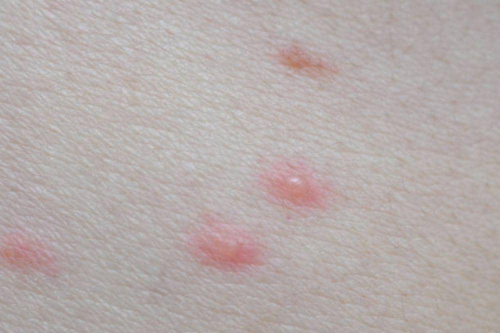 10 Ciri-Ciri Herpes Genital, Salah Satunya Tanpa Gejala!