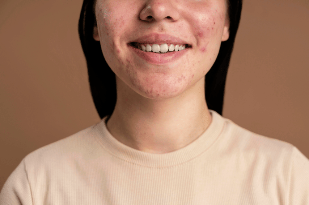 Perempuan dengan kulit berjerawat