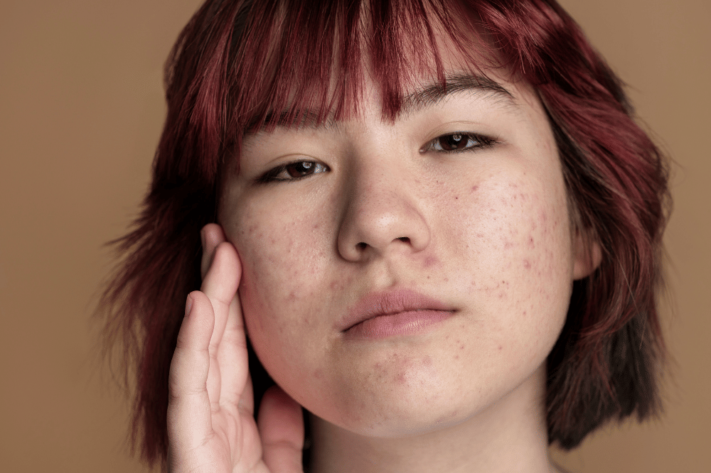 Kulit Berjerawat? Ini Alasan Remaja Pilih Skincare Berbahan Dasar Air