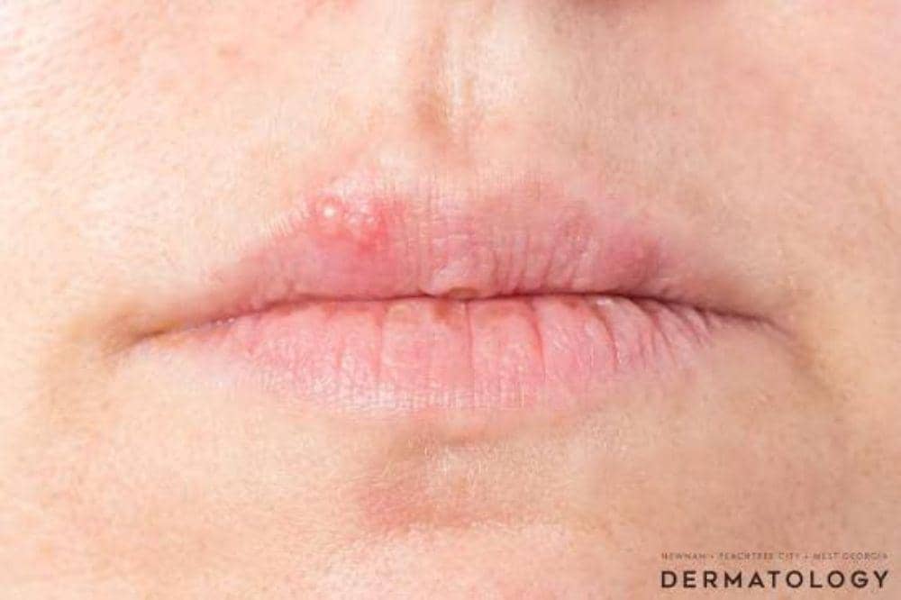 7 Cara Mengobati Herpes di Bibir, Biar Cepat Pulih Lagi.jpg