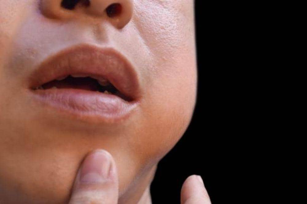 6 Gejala Herpes Labialis yang Wajib Mama Kenali, Jangan Sampai Keliru!