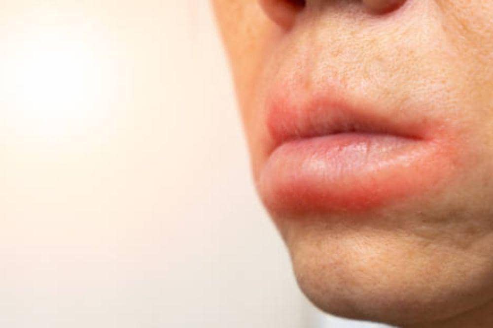 6 Ciri-Ciri Herpes di Bibir yang Jarang Disadari tapi Dapat Memburuk