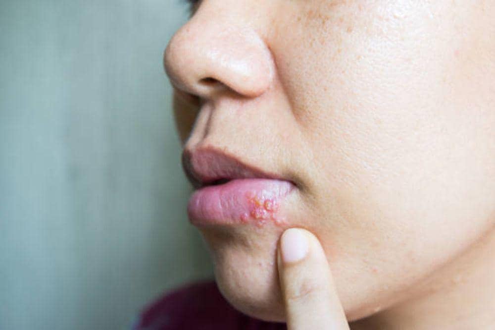 6 Ciri-Ciri Herpes di Bibir yang Jarang Disadari tapi Dapat Memburuk