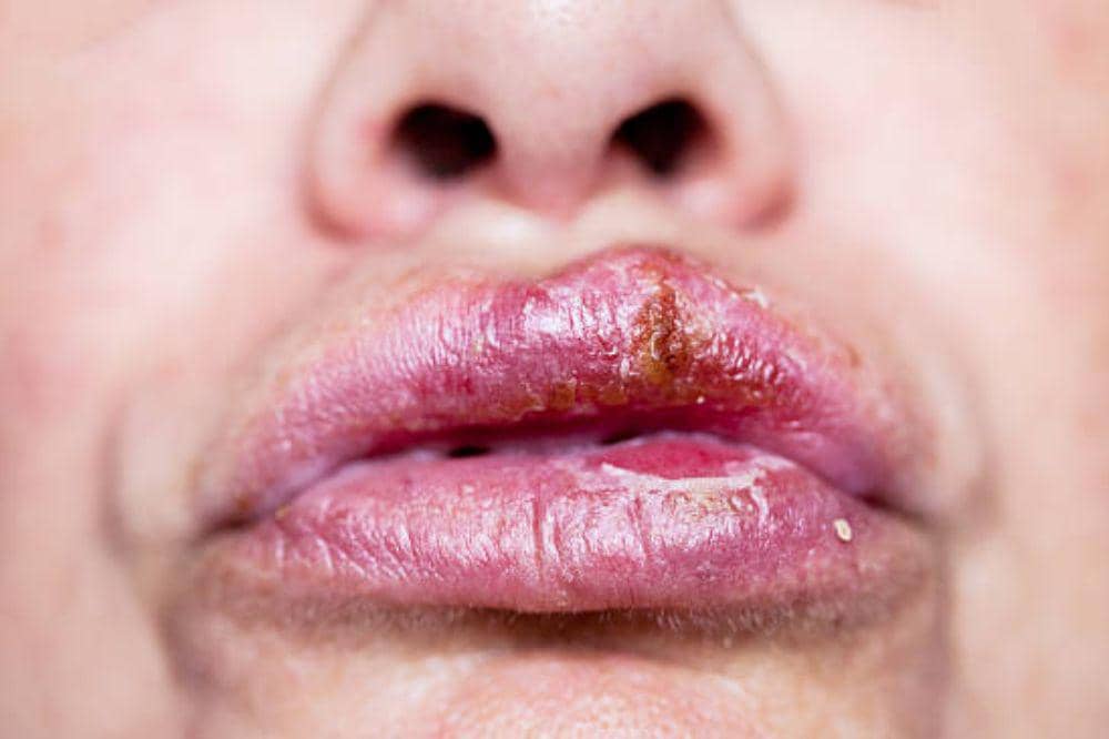6 Ciri-Ciri Herpes di Bibir yang Jarang Disadari tapi Dapat Memburuk