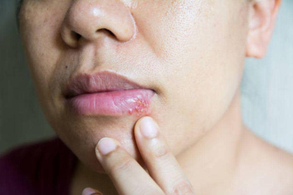6 Gejala Herpes Labialis yang Wajib Mama Kenali, Jangan Sampai Keliru!