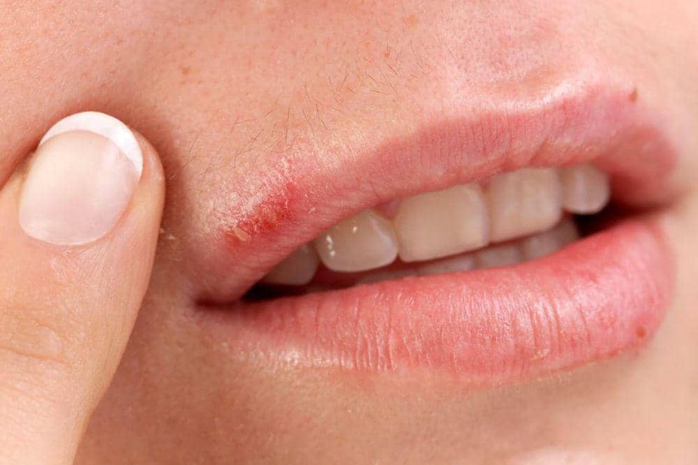 Apa Itu Herpes Labialis Infeksi Bibir yang Sering Dianggap Sariawan.jpg
