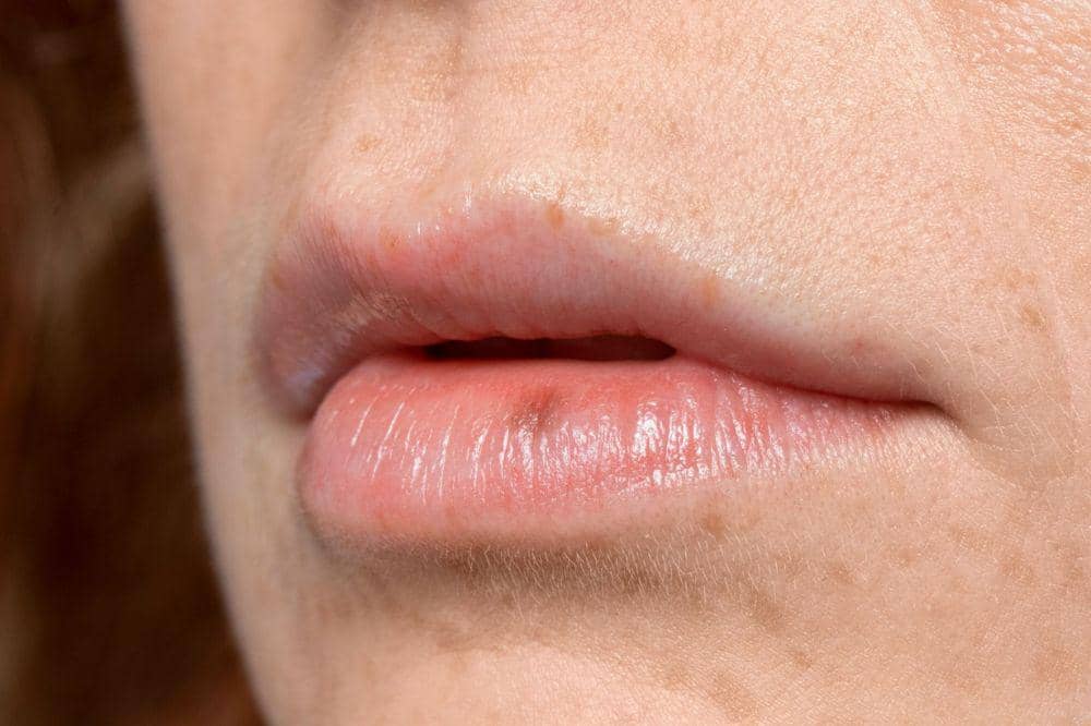 8 Penyebab Herpes di Bibir yang Wajib Dihindari