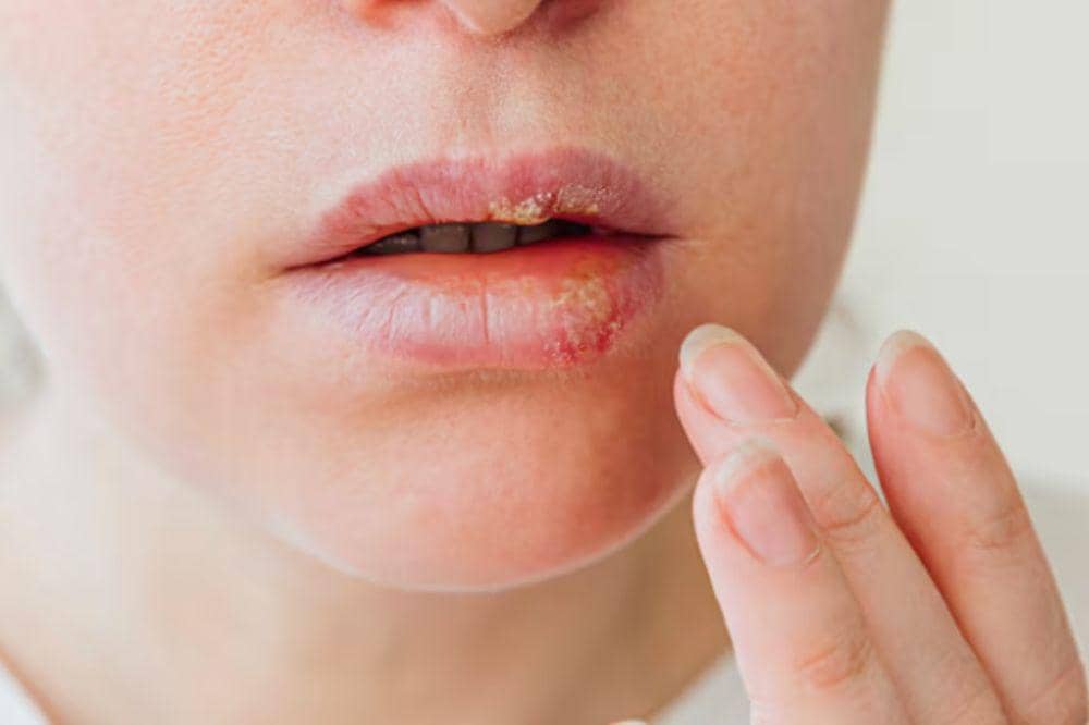 8 Penyebab Herpes di Bibir yang Wajib Dihindari