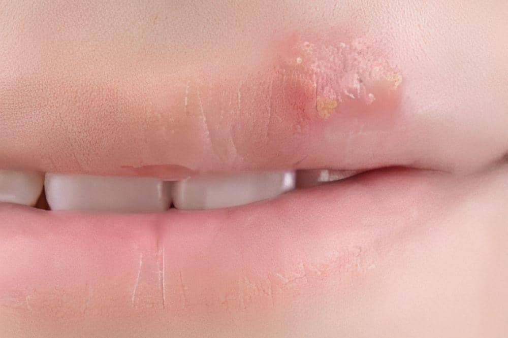 10 Jenis Perawatan Herpes Labialis yang Ampuh Redakan Gejalanya.jpg