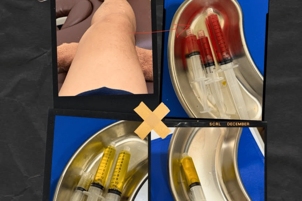 Apa Itu Cedera Meniscus yang Dialami Ariel NOAH? Ini Penjelasannya(6).png