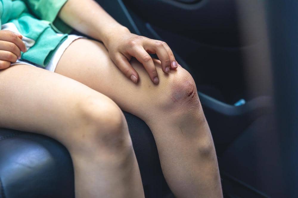 Alasan Luka Kecil Tetap Harus Dirawat, Ini Penjelasan Dokter