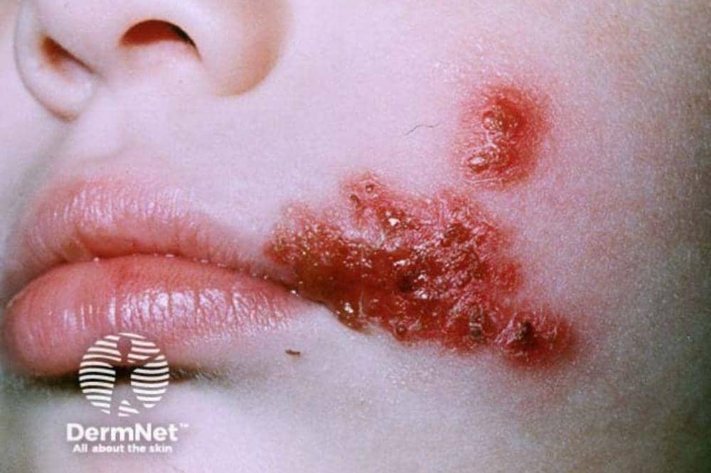 Apakah Herpes Bisa Sembuh Ini yang Harus Diketahui Sebelum Panik.jpg