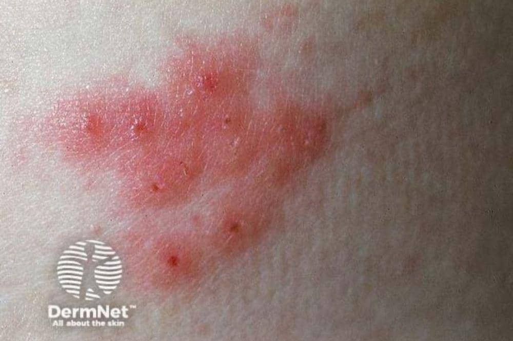 Apakah Herpes Bisa Sembuh Ini yang Harus Diketahui Sebelum Panik (1).jpg
