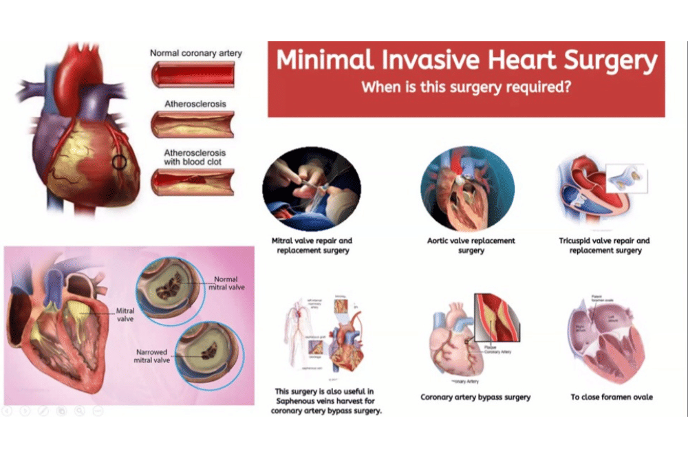 Pertama di Indonesia, Operasi MICS 3 Prosedur Berhasil pada Pasien Jantung ASD   (3).png