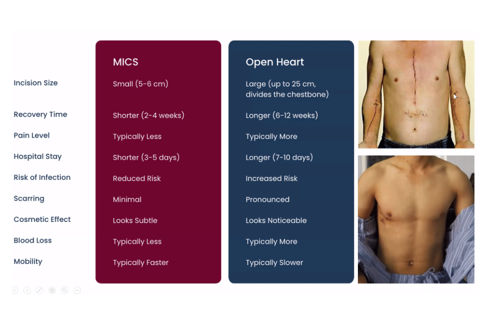 Pertama di Indonesia, Operasi MICS 3 Prosedur Berhasil pada Pasien Jantung ASD  (1).png
