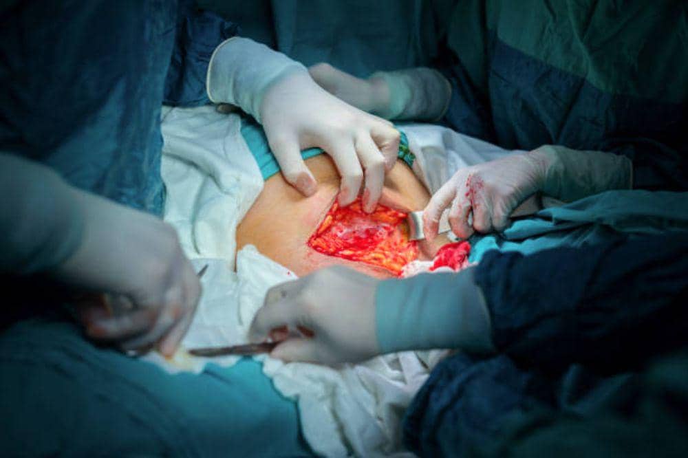 Prosedur Operasi Hernia: Tahapan Medis, Jenis Tindakan, dan Pemulihan