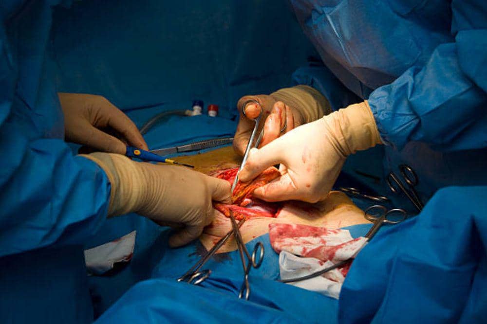 Operasi Hernia Inguinalis dan Proses Pemulihannya