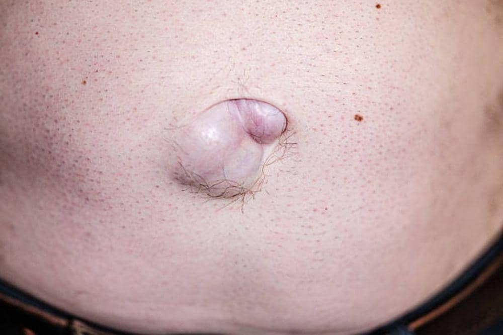 7 Jenis Hernia, Kenali Lokasi dan Cara Penanganannya!