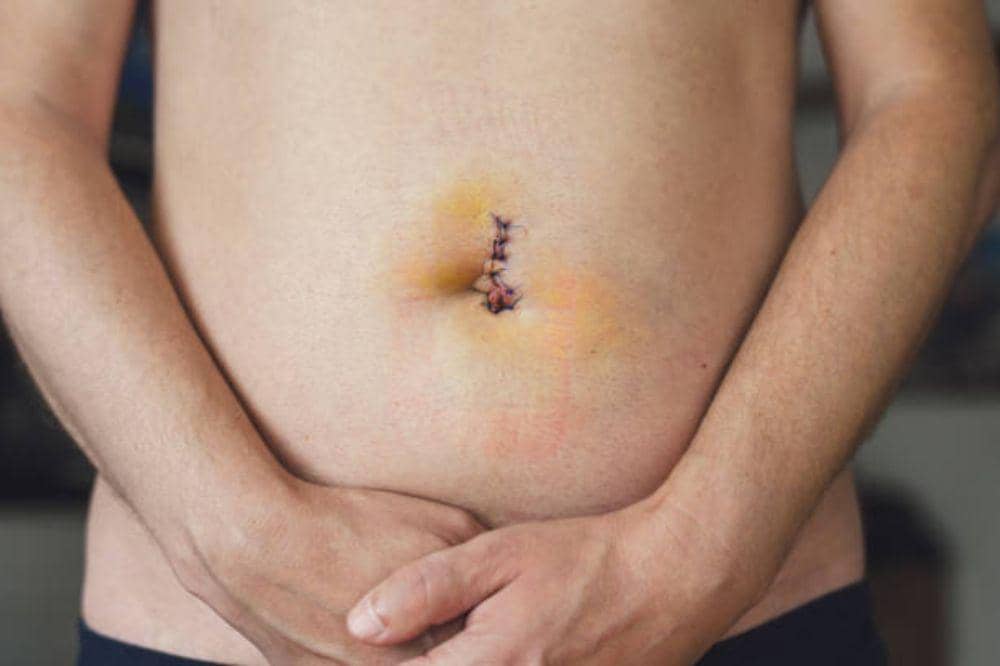 7 Jenis Hernia, Kenali Lokasi dan Cara Penanganannya!