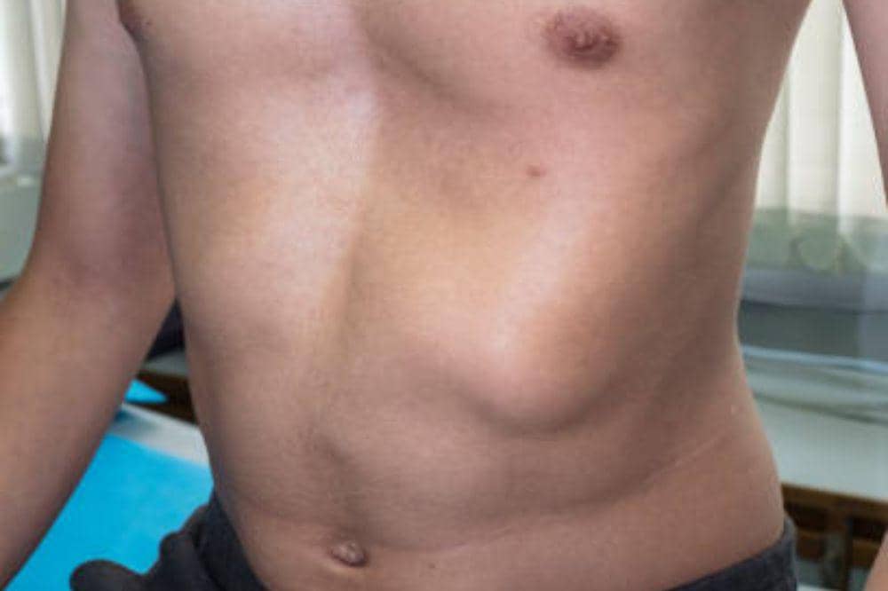 7 Jenis Hernia, Kenali Lokasi dan Cara Penanganannya!