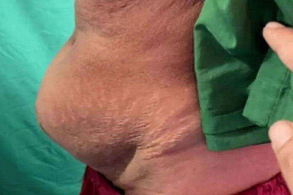 Apakah Hernia Berbahaya Ternyata Komplikasi Juga Bisa Terjadi (1).jpg